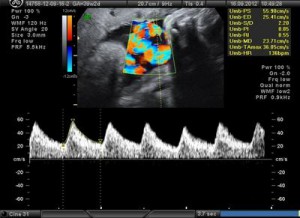 Допплерометрия при беременности