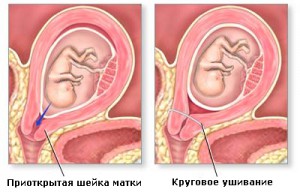 Истмико-цервикальная недостаточность